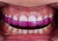 Estrés incrementa el riesgo de pérdida de dientes