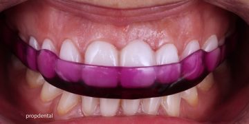 Estrés incrementa el riesgo de pérdida de dientes