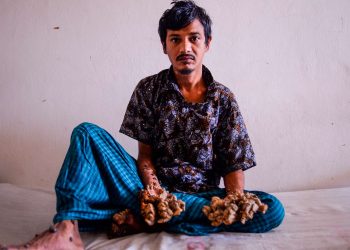 Hombre conocido como “hombre-árbol” desea que le amputen las manos