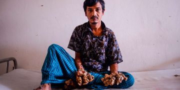 Hombre conocido como “hombre-árbol” desea que le amputen las manos