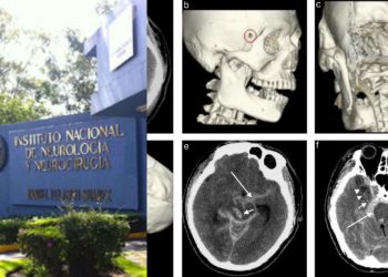 El Instituto Nacional de Neurología deja de realizar procedimientos por falta de recursos