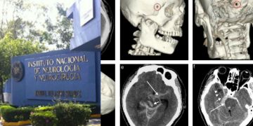 El Instituto Nacional de Neurología deja de realizar procedimientos por falta de recursos