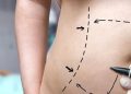 Mujer murió por liposucción en Tabasco