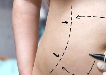 Mujer murió por liposucción en Tabasco