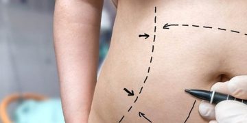 Mujer murió por liposucción en Tabasco
