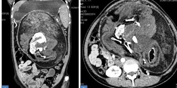 ¡Sorprendente! Joven vive con un ‘gemelo’ dentro de su cuerpo sin saberlo