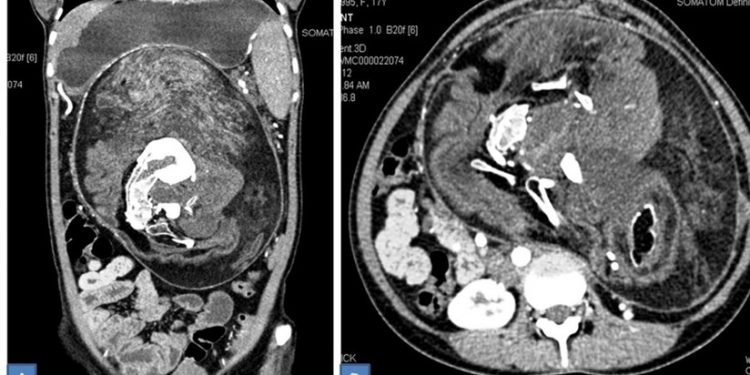 ¡Sorprendente! Joven vive con un ‘gemelo’ dentro de su cuerpo sin saberlo