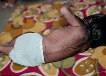 Bebés sufren ‘síndrome del hombre lobo’ por tomar omeprazol