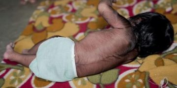 Bebés sufren ‘síndrome del hombre lobo’ por tomar omeprazol