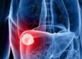 Es un mito que el cáncer hepático sólo aparezca en pacientes alcohólicos