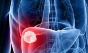 Es un mito que el cáncer hepático sólo aparezca en pacientes alcohólicos