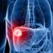 Es un mito que el cáncer hepático sólo aparezca en pacientes alcohólicos