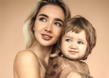 Una influencer visibilizó la extraña enfermedad que padece su hijo en la piel