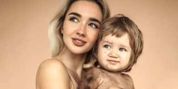 Una influencer visibilizó la extraña enfermedad que padece su hijo en la piel