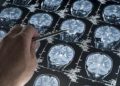 Rara mutación protege contra el Alzheimer a una mujer colombiana