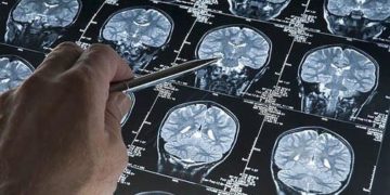 Rara mutación protege contra el Alzheimer a una mujer colombiana
