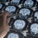 Rara mutación protege contra el Alzheimer a una mujer colombiana