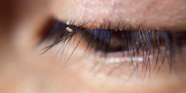 Advierten sobre peligro de piojos en pestañas