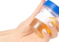 Prueba de orina podría suplir al papanicolaou en detección de cáncer