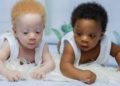 Gemelos en Nigeria nacen con diferente color de piel