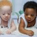 Gemelos en Nigeria nacen con diferente color de piel