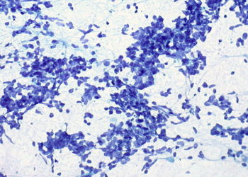 Trazan las líneas generales de un nuevo tratamiento para el cáncer
