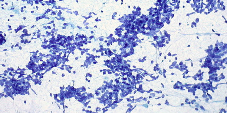 Trazan las líneas generales de un nuevo tratamiento para el cáncer