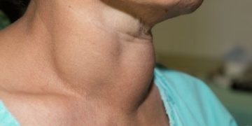 Lipomas, causas y tratamiento