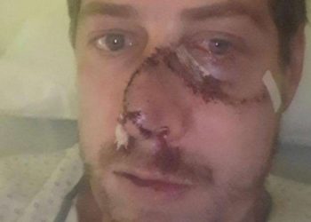 Un ciervo le arrancó parte de la cara a un cazador