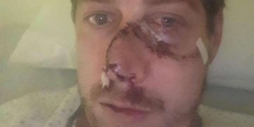 Un ciervo le arrancó parte de la cara a un cazador
