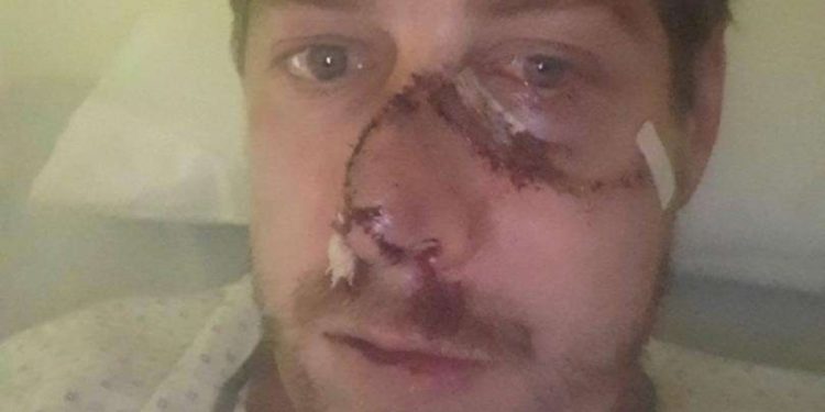 Un ciervo le arrancó parte de la cara a un cazador