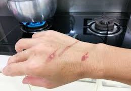 ¿Cómo atender una quemadura en casa?