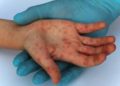 Sarampión preocupa más que el coronavirus: Centros de Salud