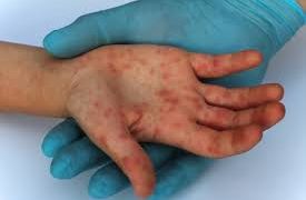 Sarampión preocupa más que el coronavirus: Centros de Salud
