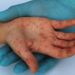 Sarampión preocupa más que el coronavirus: Centros de Salud