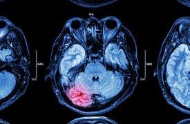 ¿El coronavirus puede causar accidentes cerebrovasculares en adultos jóvenes?