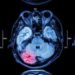 ¿El coronavirus puede causar accidentes cerebrovasculares en adultos jóvenes?