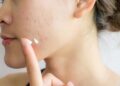 Tips para desvanecer o eliminar las cicatrices