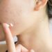 Tips para desvanecer o eliminar las cicatrices