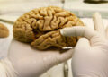 Crean banco de cerebros en la UNAM para investigación de Alzheimer