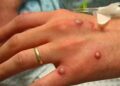 Señalan fiesta masiva en España como brote de infección de viruela del mono