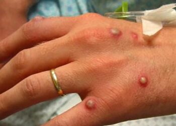 Señalan fiesta masiva en España como brote de infección de viruela del mono