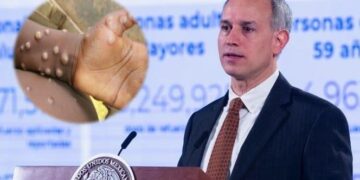 López-Gatell confirma primer caso de viruela del mono en México