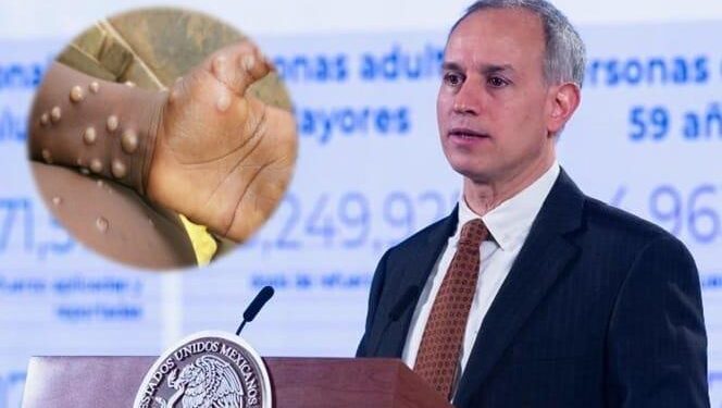 López-Gatell confirma primer caso de viruela del mono en México
