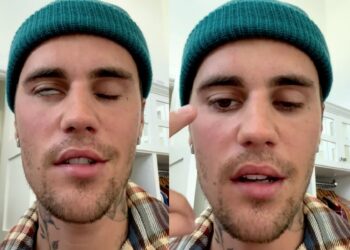 ¿Qué es el síndrome de Ramsay Hunt?; el cual padece Justin Bieber