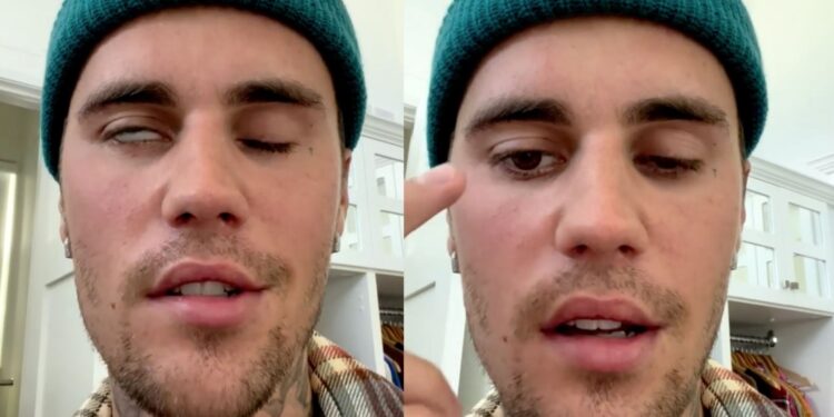 ¿Qué es el síndrome de Ramsay Hunt?; el cual padece Justin Bieber