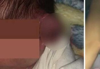 Practican cesárea con linternas de celular y le cortan la oreja al bebé en Mexicali