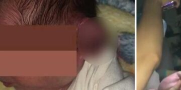 Practican cesárea con linternas de celular y le cortan la oreja al bebé en Mexicali