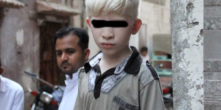Detienen a hombre que intentó vender a sus hijos albinos para rituales de brujería