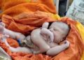 Nació un bebé con cuatro brazos y cuatro piernas en la India.